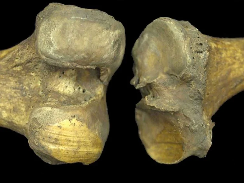 “6000-Year-Old Knee Joints suggest Osteoarthritis Isn’t just Wear and Tear”