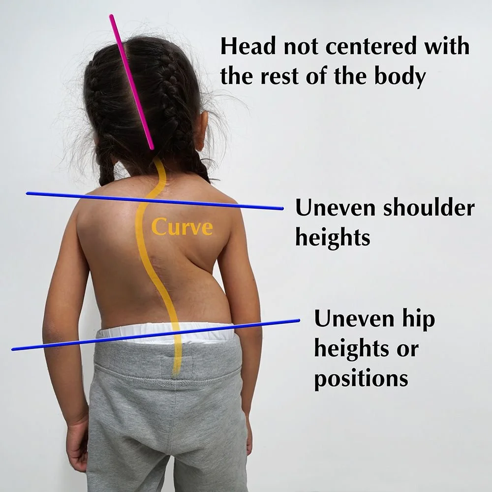 What is Scoliosis, and how you can test your child 