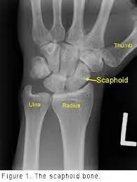 Scaphoid Fractures 