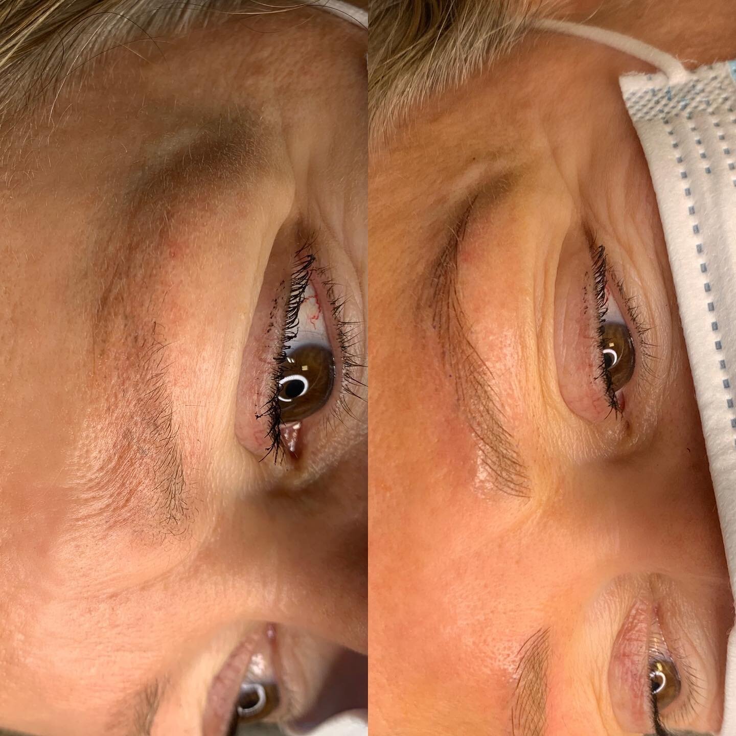 This beautiful client had her brows microbladed by another artist about a year ago and was not happy with the color, size or shape.  She let them fade and came in for a re-work.  They&rsquo;re now placed on her actual eyebrows and not above them and 