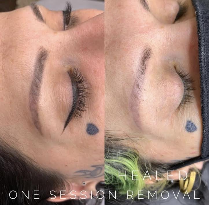 Laser Tattoo Removal for eyebrows  Goodbye Tattoos