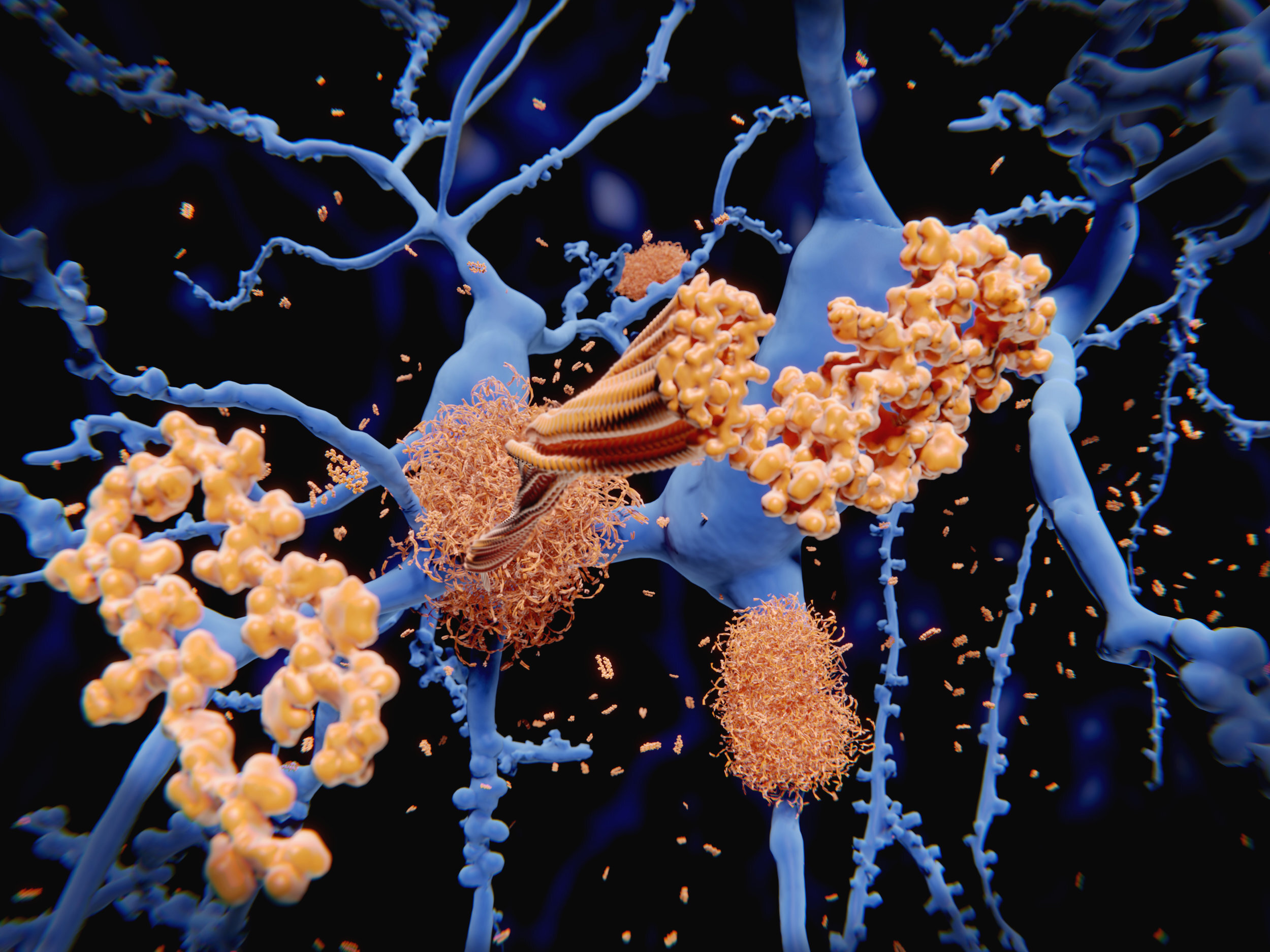 PICTURED: The tau-protein “beta-amyloid” that forms plaques around the neurons in the brain: the principle agent of Alzheimer’s Disease.