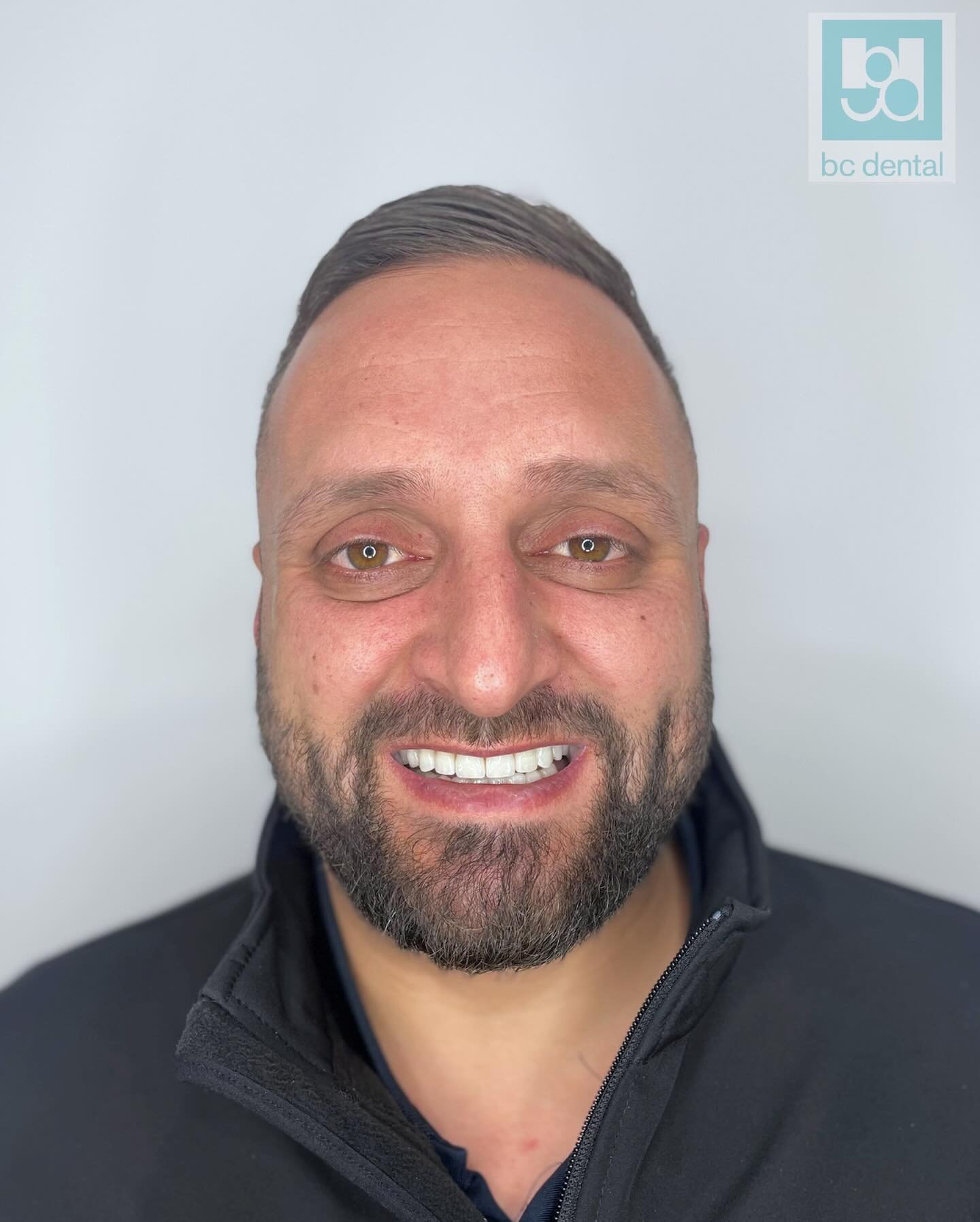 Patient ✨ transformation ✨Tuesday! 

A great result for our wonderful patient who wanted to brighten up his smile. @drvalroberts completed this transformation with Veneers and our patient can&rsquo;t stop smiling - you can see why 😁😁

#bcdental #ba