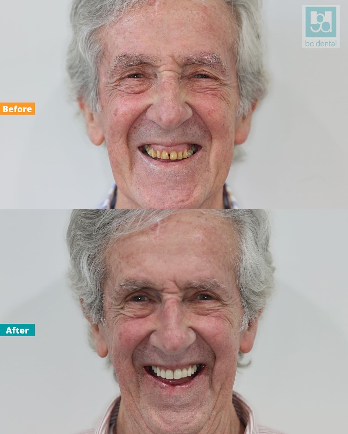 We absolutely LOVE this transformation! Unhappy with his smile, our patient&rsquo;s journey involved a combination of Invisalign treatment, whitening and veneers ✨

What a result! Stay tuned for more details 🦷 #bcdental #veneers #teethwhitening #inv