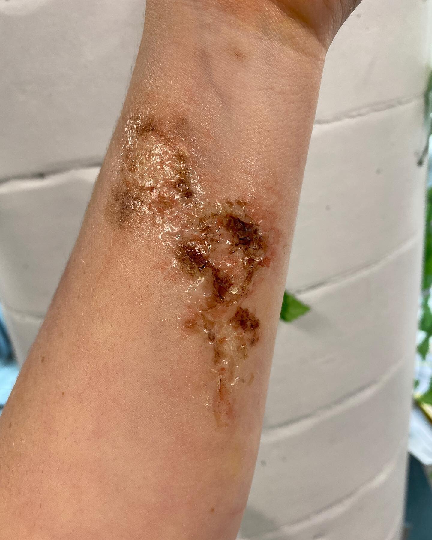 Nasty little chemical burn done with @alconefx 3rd degree silicone and alcohol paints. 
#sfxmakeup #burnmakeup #sfxmakeupartist #sfxmakeupmelbourne #woundsandinjuries #outofkitfx #chemicalburn #sfxmua