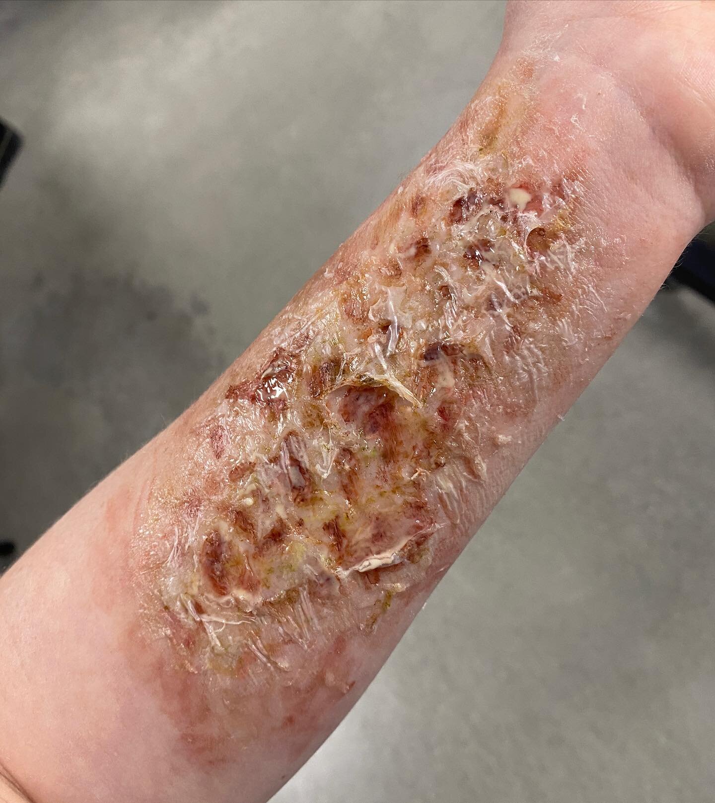 Another day, another burn 🔥 
This one was made with an underlay of @alconefx 3rd degree silicone and topped with a melted layer of plasticap. 🫠🫠🫠
#sfxmakeup #sfxmakeupartist #sfxmua #sfxmelbourne #burnmakeup #burns #thirddegreeburns #chemicalburn
