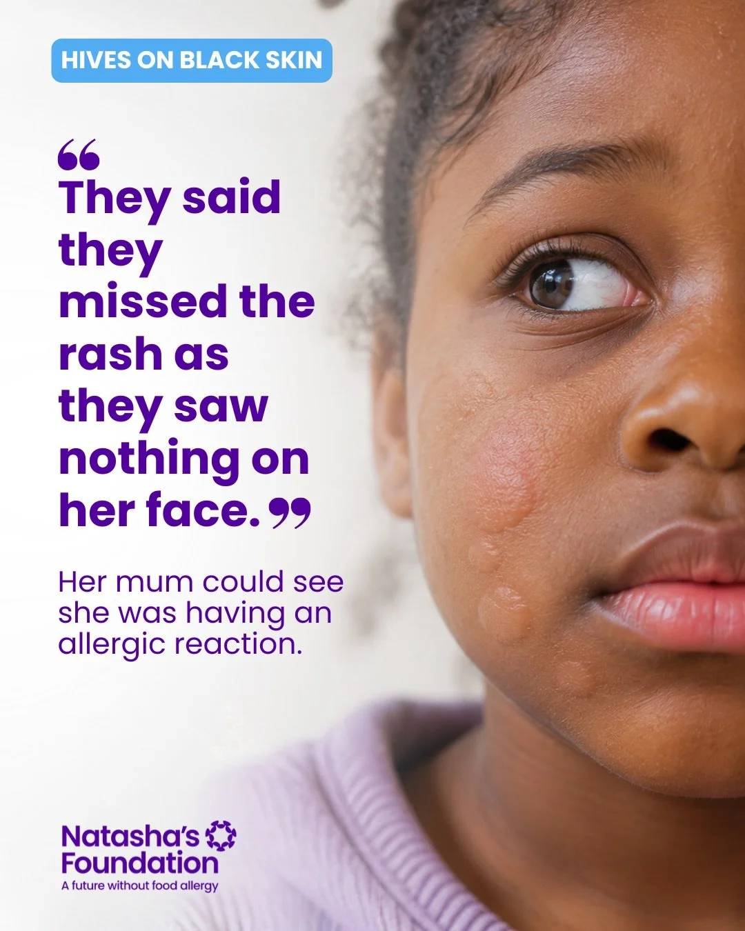 More needs to be done to raise awareness of what hives, also called urticaria, can look like on brown and black skin.

@amzchohan shared with us:

&ldquo;My daughter came home from school with a rash beside her lip. To us, it was obvious. She had com