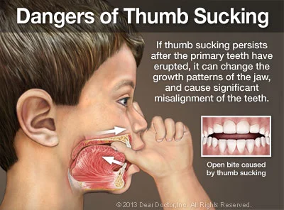 dangers-of-thumb-sucking-thumb.jpg