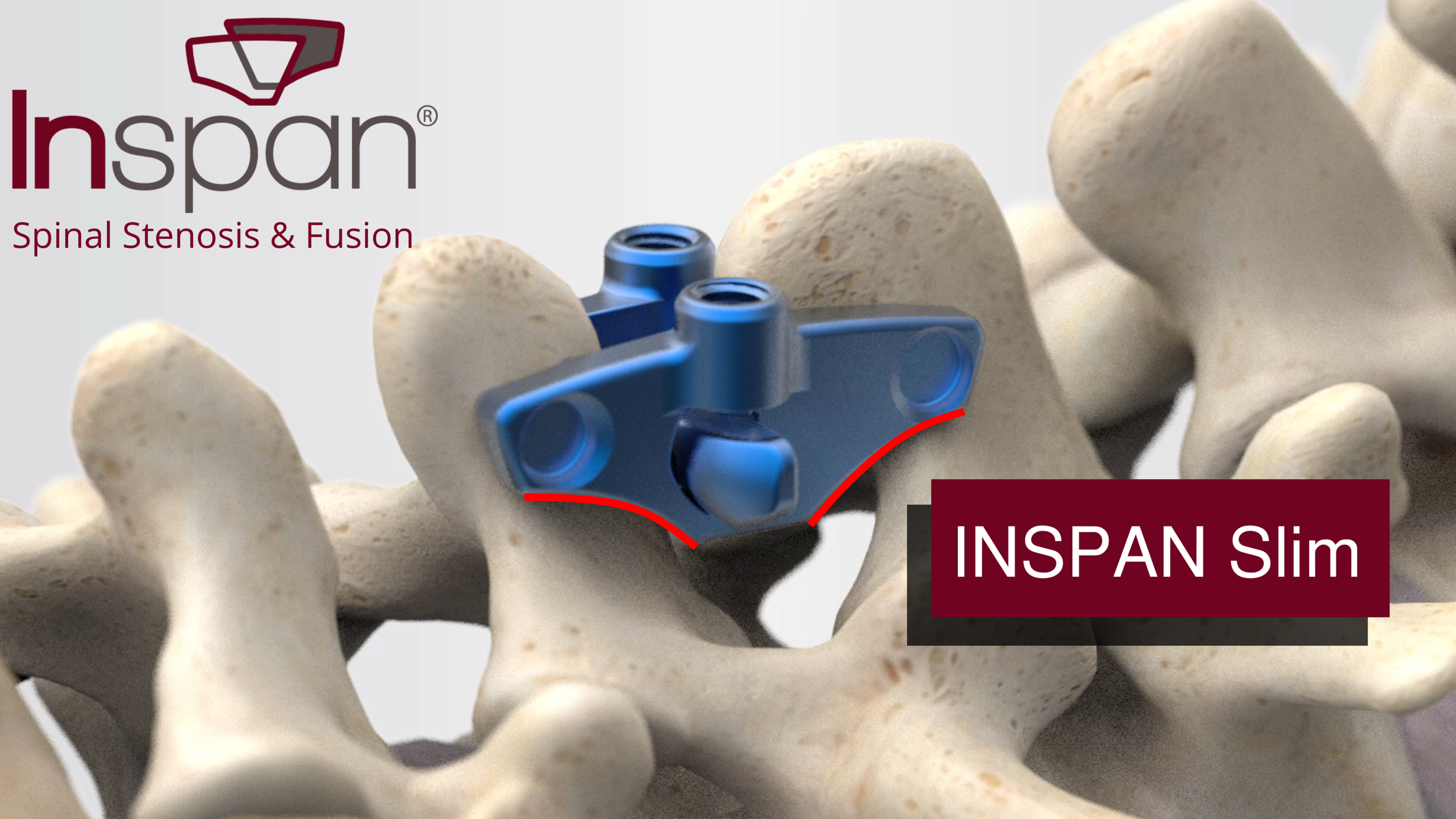 Interspinous Implant Schematic Representation Of The (a) DIAM, (b)