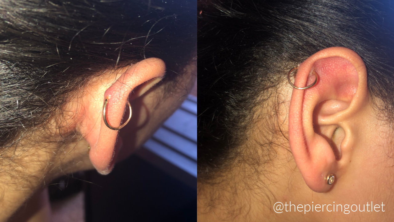 Industrial Piercing How To Heal Keloid On Cartilage Industrial