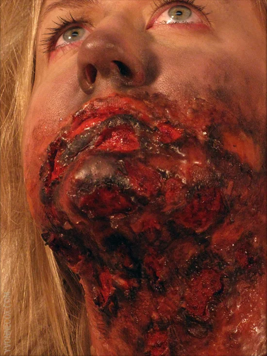 3rddegreeburn2wm.jpg