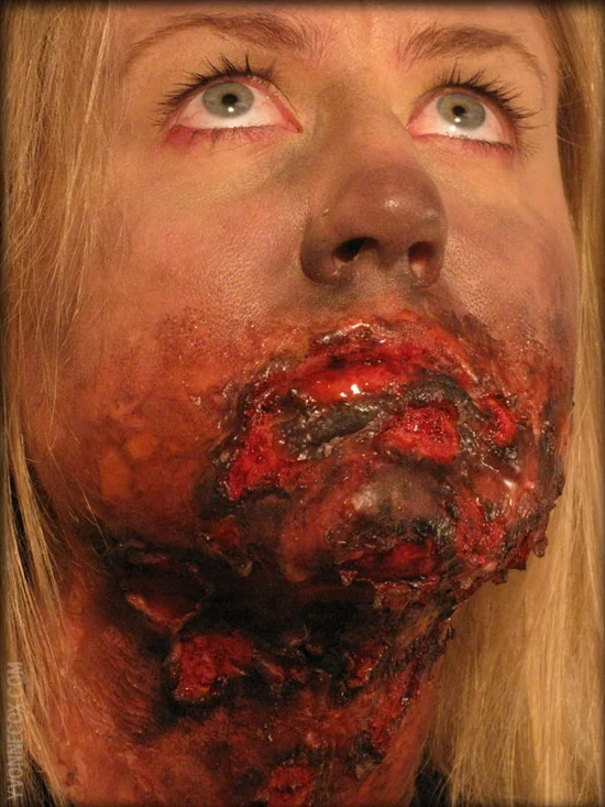 3rddegreeburn1wm.jpg
