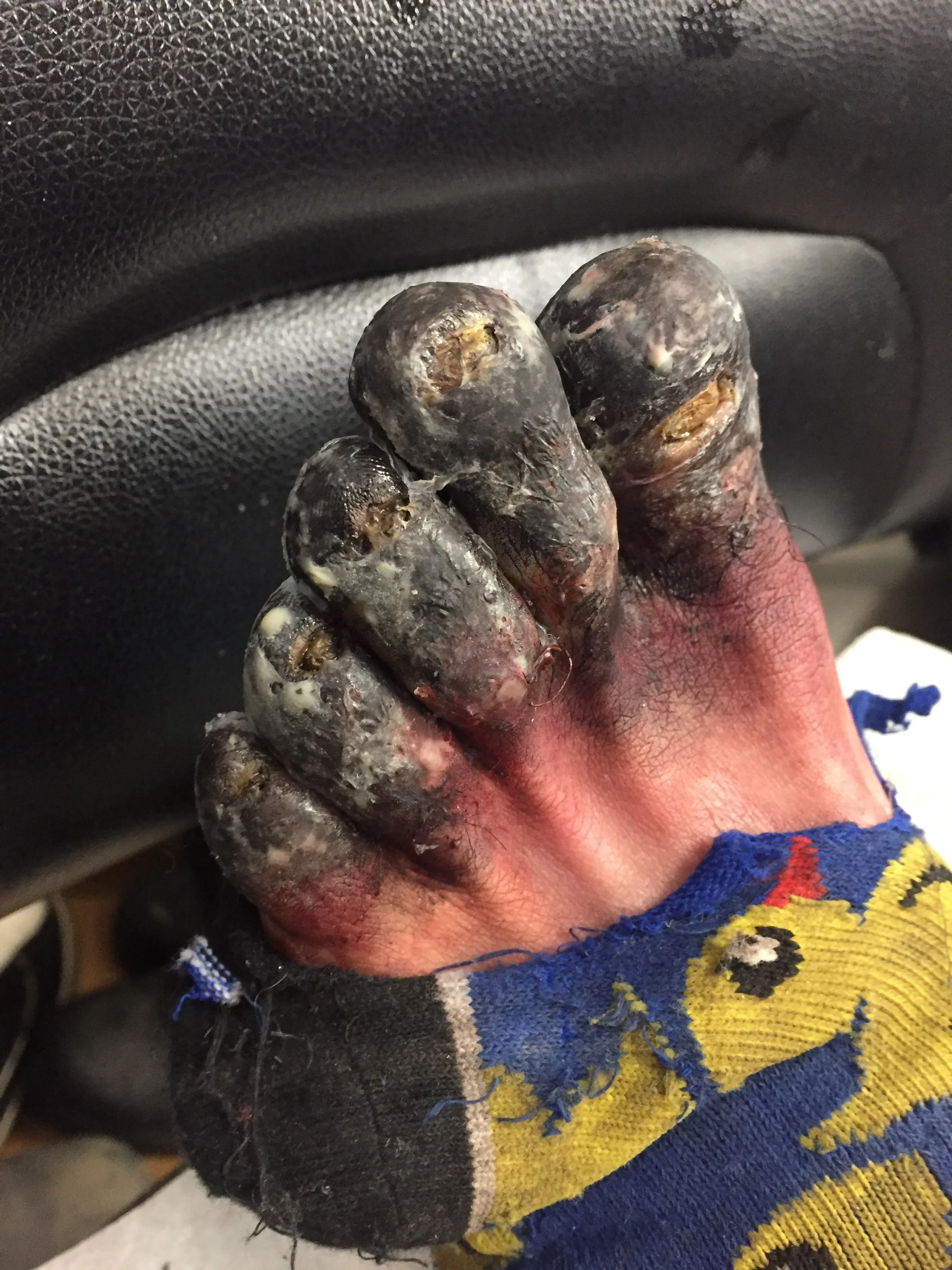  Frost bitten toes for Black Summer S2. 