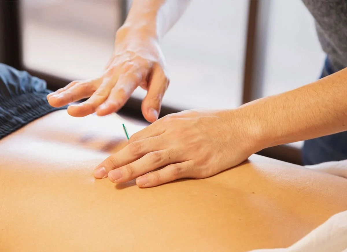 Physical Therapist performing dry needling for client during Physical Therapy session