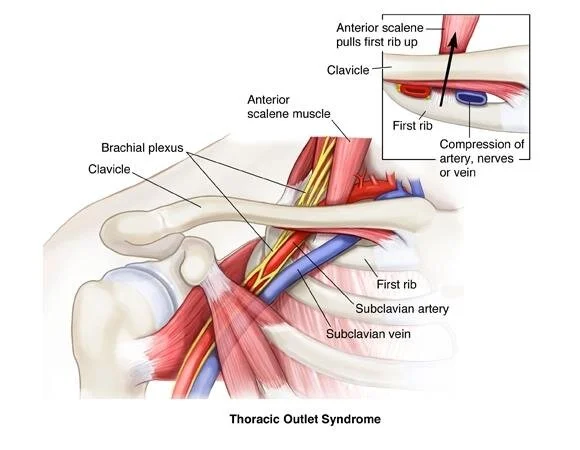 Thoracic Outlet Syndrome A Nerve Compression Frequently Overlooked Onsite Health