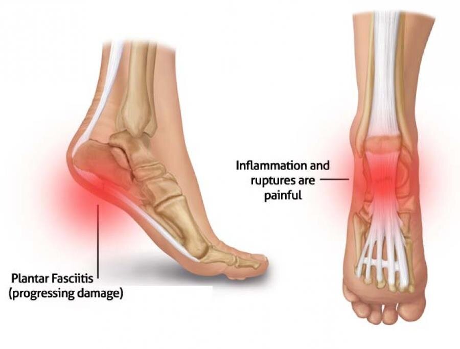 Plantar Fasciitis Onsite Health