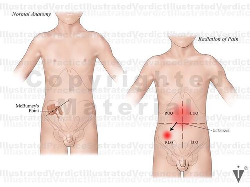 Stock Appendix: Appendicitis / Retrocecal — Illustrated Verdict