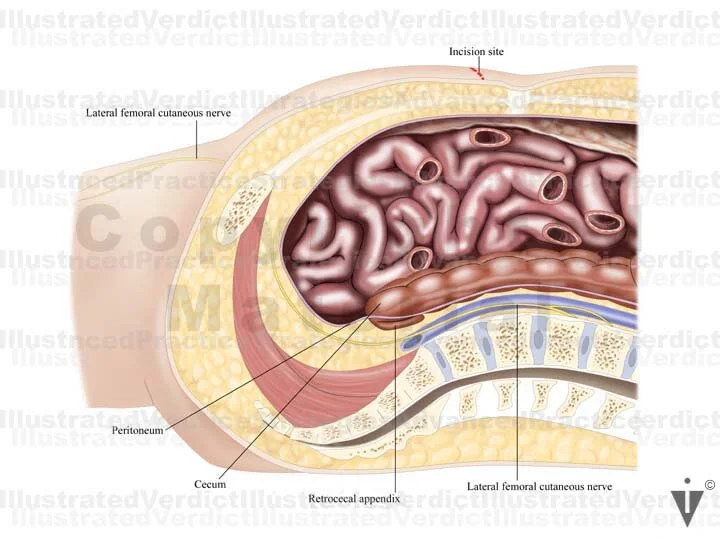 Stock Appendix: Appendicitis / Retrocecal — Illustrated Verdict