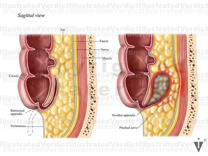 Stock Appendix: Appendicitis / Retrocecal — Illustrated Verdict