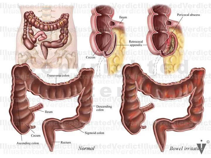 Stock Appendix: Appendicitis / Retrocecal — Illustrated Verdict