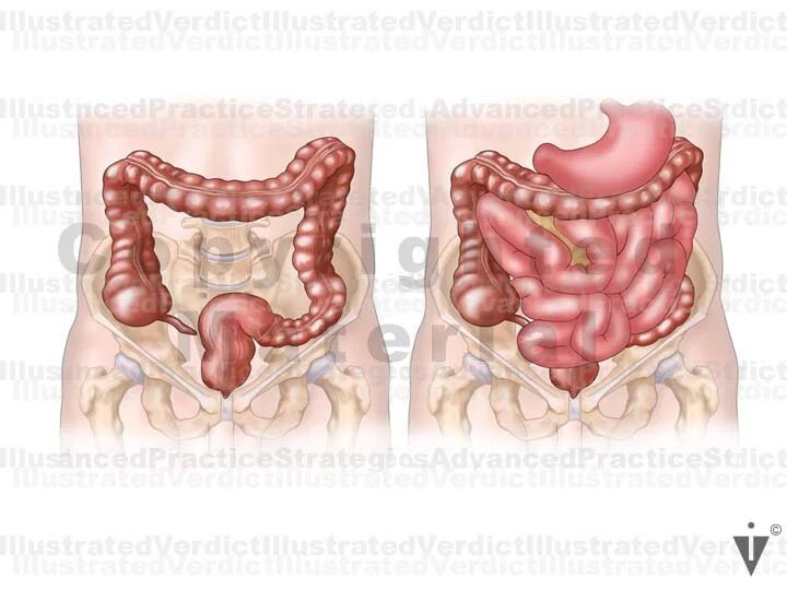 Stock Bowel: Normal Anatomy — Illustrated Verdict