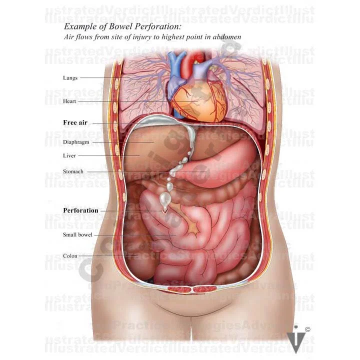 Stock Bowel: Anomalies / Obstructions / Injuries — Illustrated Verdict