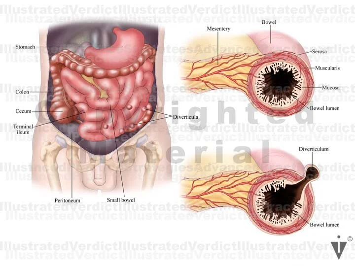 Stock Bowel: Anomalies / Obstructions / Injuries — Illustrated Verdict