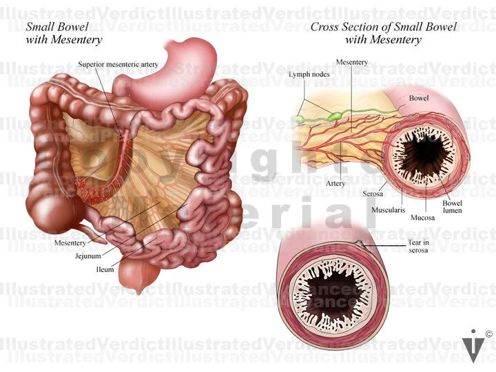 Small Intestine Injury Stock Bowel: Anomalies / Obstructions / Injuries — Illustrated Verdict