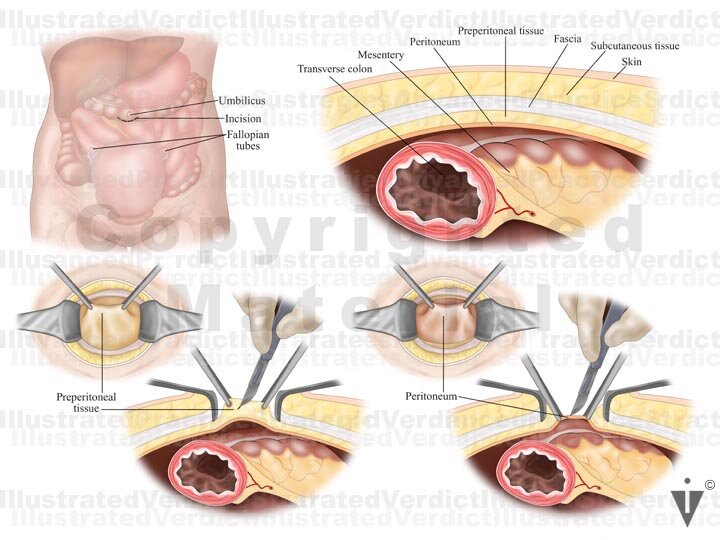 Stock Bowel: Abdominal / Pelvic Surgical Approach — Illustrated Verdict