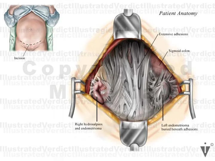 Stock Bowel: Abdominal / Pelvic Surgical Approach — Illustrated Verdict