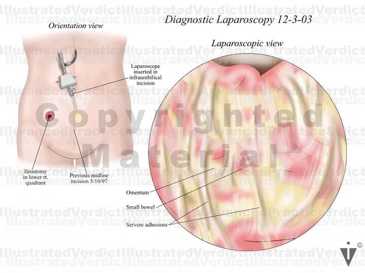 Stock Bowel: Abdominal / Pelvic Surgical Approach — Illustrated Verdict