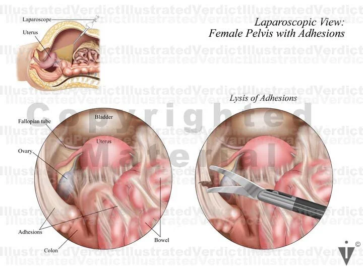 Stock Bowel: Abdominal / Pelvic Surgical Approach — Illustrated Verdict