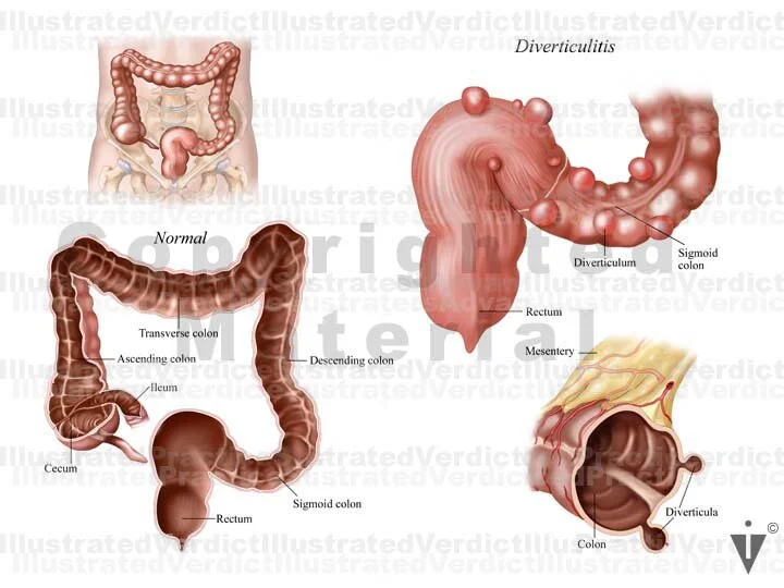 Stock Colon: Diverticulitis — Illustrated Verdict