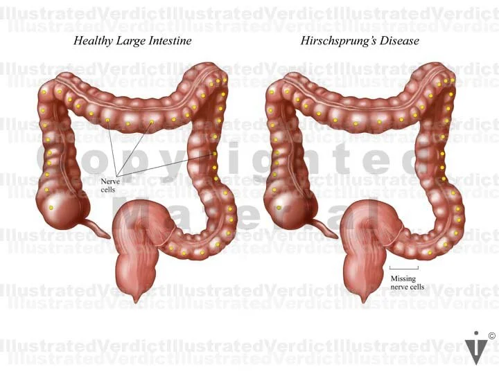 Stock Colon: Infections / Diseases — Illustrated Verdict