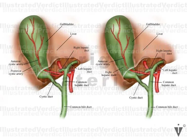 Stock Gallbladder: Variations (ducts, arteries, stones, tumors ...