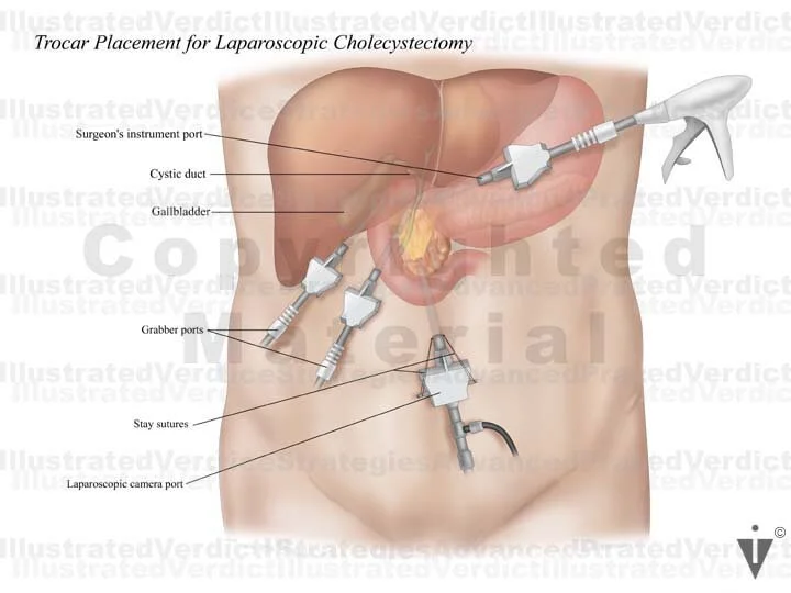 Laparoscopic Cholecystectomy laparoscopic-cholecystectomy
