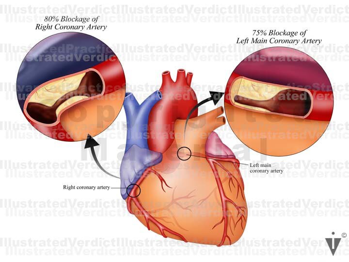 Stock Heart: Coronary Artery Disease and Myocardial Infarction ...