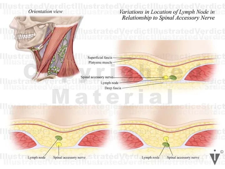 Stock Neck: Lymph Node Biopsy — Illustrated Verdict