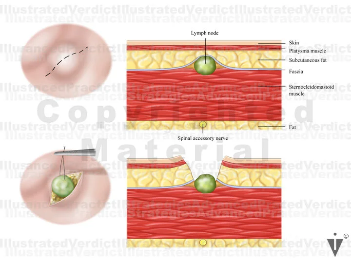 Stock Neck Lymph Node Biopsy Illustrated Verdict Stock Neck Lymph Node Biopsy Illustrated Verdict