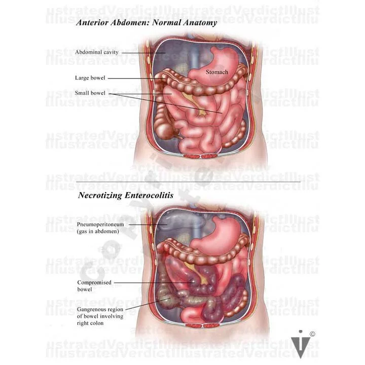 Stock Bowel: Anomalies / Obstructions / Injuries — Illustrated Verdict
