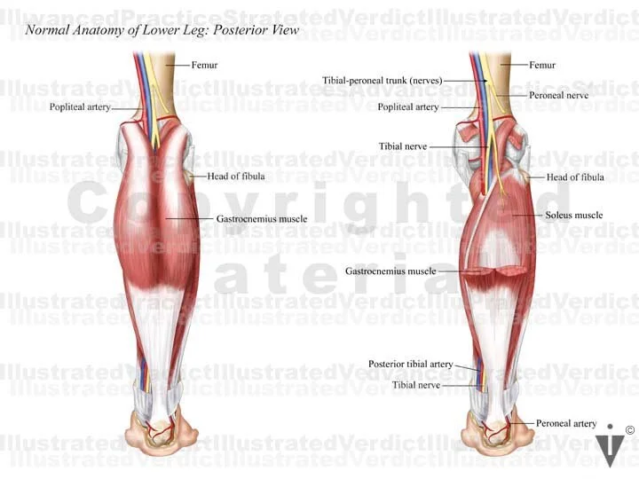 Stock Lower Limb Compartment Syndrome — Illustrated Verdict