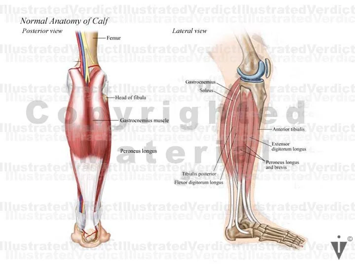 Stock Lower Limb Compartment Syndrome — Illustrated Verdict