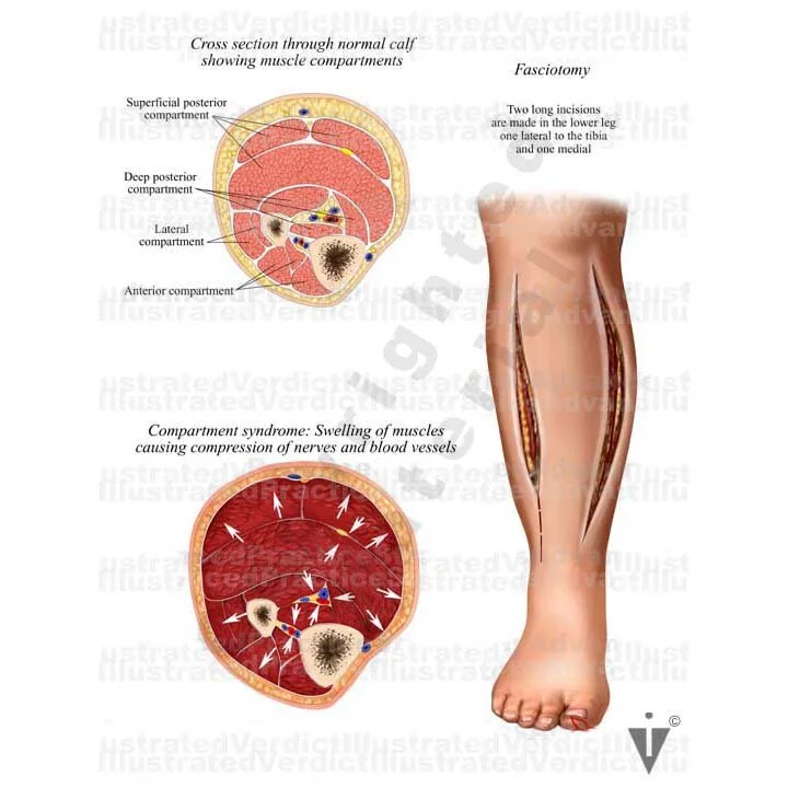 Stock Lower Limb Compartment Syndrome — Illustrated Verdict
