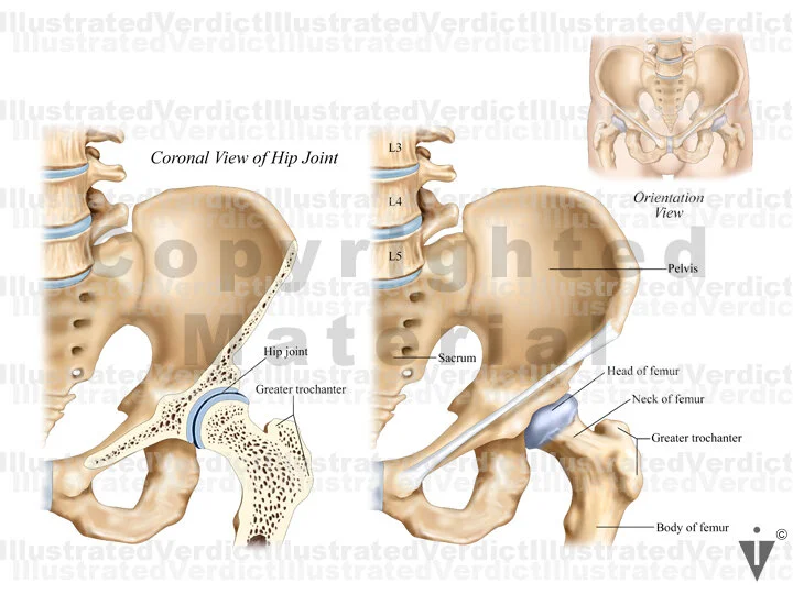 Stock Hip: Normal Anatomy — Illustrated Verdict