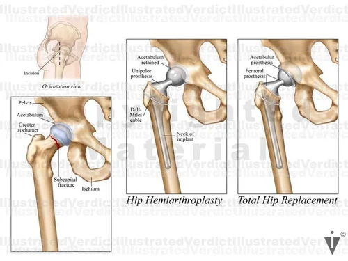 Hip Transposition Stock Hip: Replacement — Illustrated Verdict