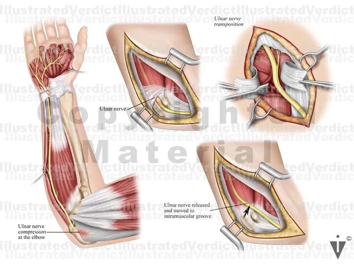 Ulnar Nerve Transposition