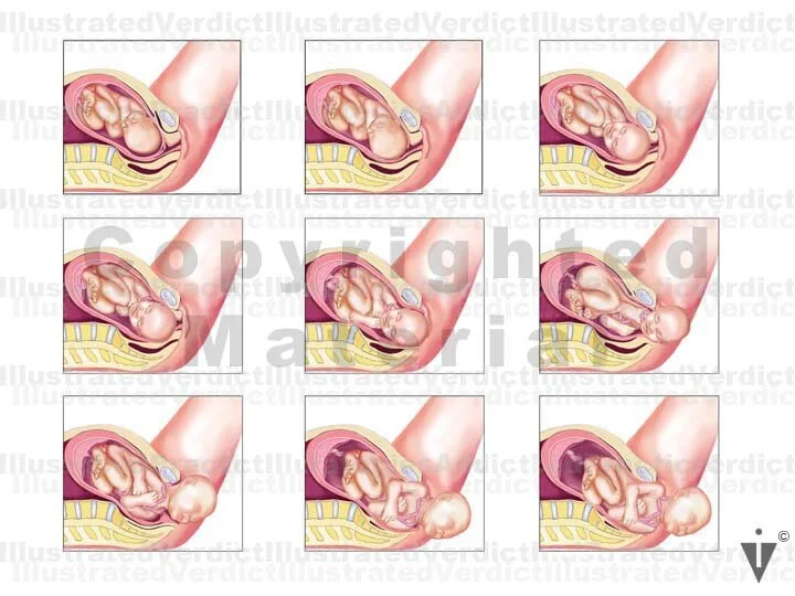 Stock Pregnancy / Delivery: Normal Delivery — Illustrated Verdict
