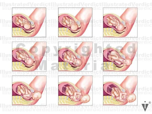 Stock Pregnancy / Delivery: Normal Delivery — Illustrated Verdict