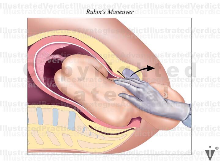 Stock Pregnancy / Delivery: Shoulder Dystocia / Maneuvers — Illustrated  Verdict