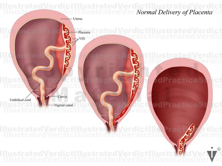 Placenta Delivery